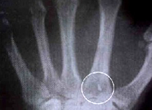 Implants Extraterrestres : Radiographie d'un implant.